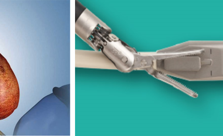 Video giới thiệu đầu dò siêu âm trong phẫu thuật Robotic